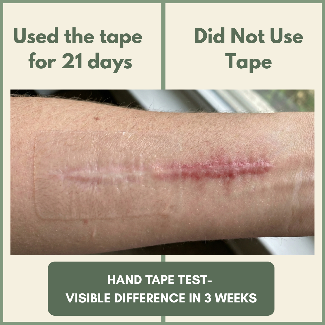 VesperLane™ Medical-Grade Silicone Scar Therapy Roll (1.5m)