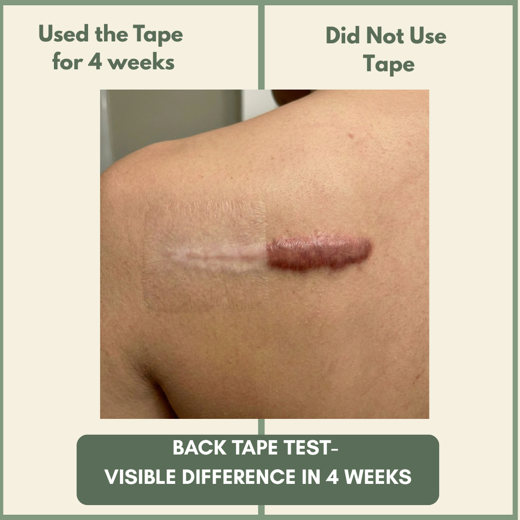 VesperLane™ Medical-Grade Silicone Scar Therapy Roll (1.5m)
