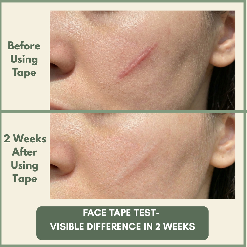 VesperLane™ Medical-Grade Silicone Scar Therapy Roll (1.5m)